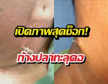 เห็นแล้วต้องขนลุก!ก้างติดคออย่าปล่อยไว้นาน อันตรายมาก!